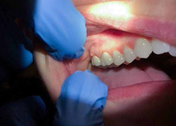 Best Emergency Tooth Extraction  in Stanton, CA